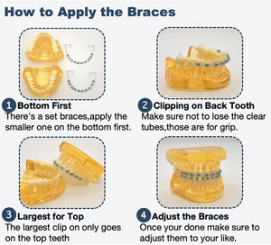 One Step Fake Braces Kit Clip With Power Chain