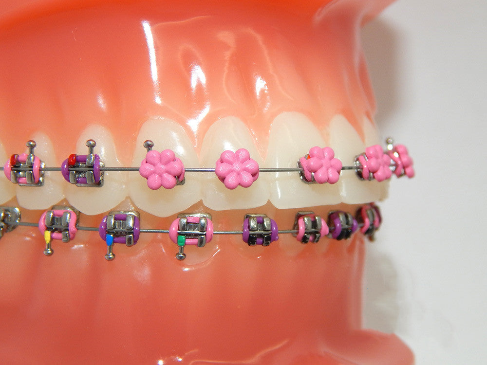Fun Braces Ligature Ties