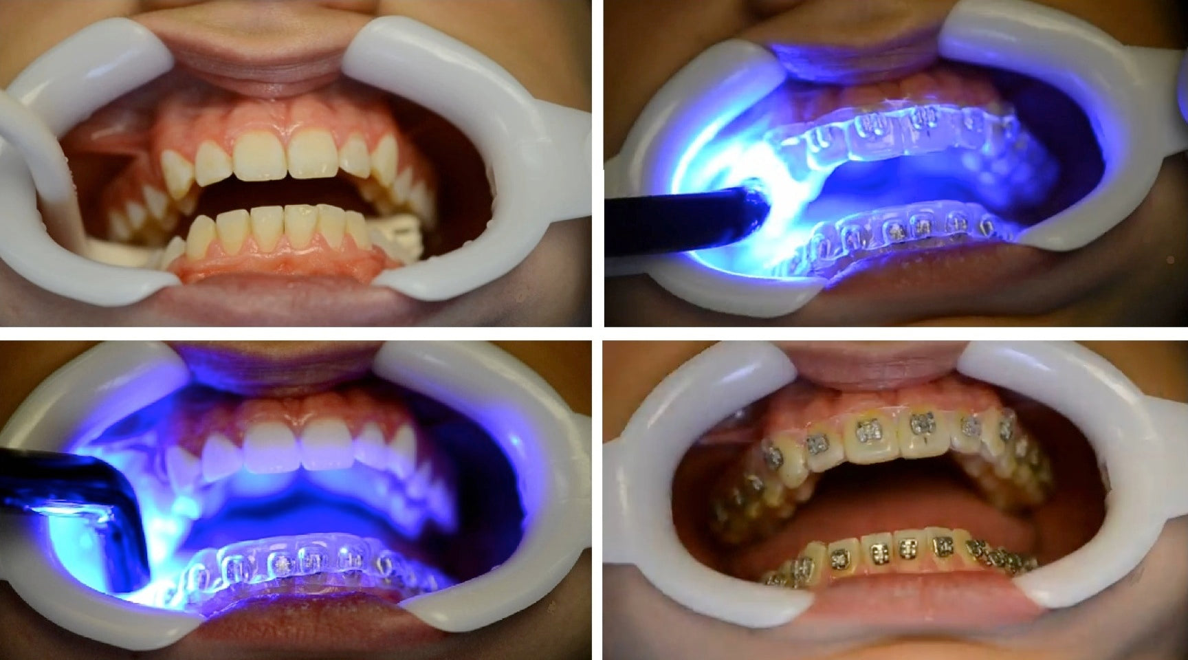 Braces Bonding Teeth Gems Glue Light Cure Adhesive