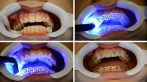 Braces Bonding Teeth Gems Glue Light Cure Adhesive